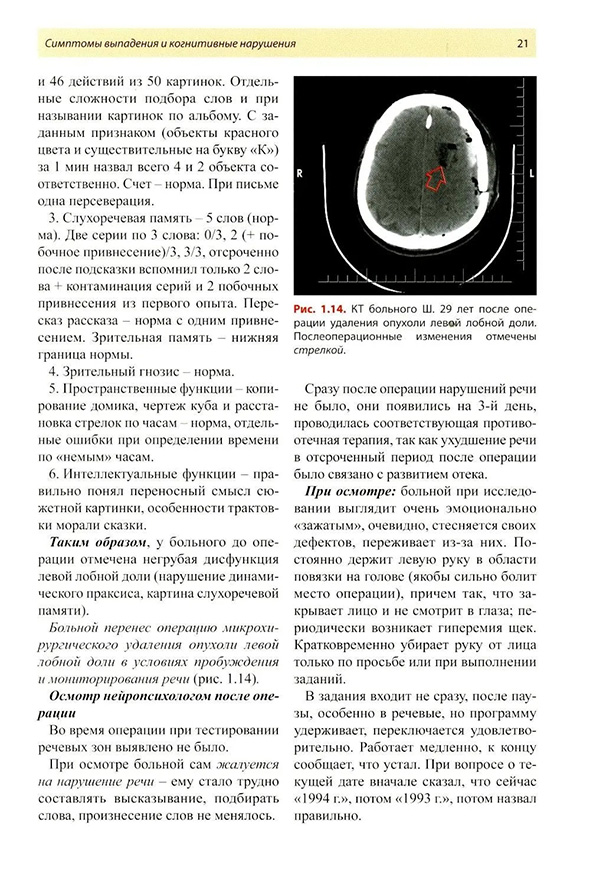 Рис. 1.14. КТ больного Ш. 29 лет после операции удаления опухоли левой лобной доли. Послеоперационные изменения отмечены стрелкой.