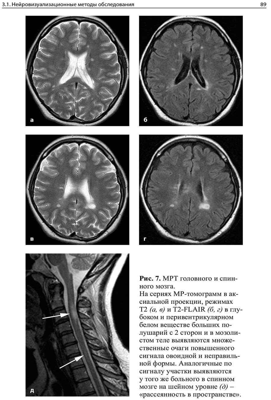 Рис. 7. MPT головного и спинного мозга