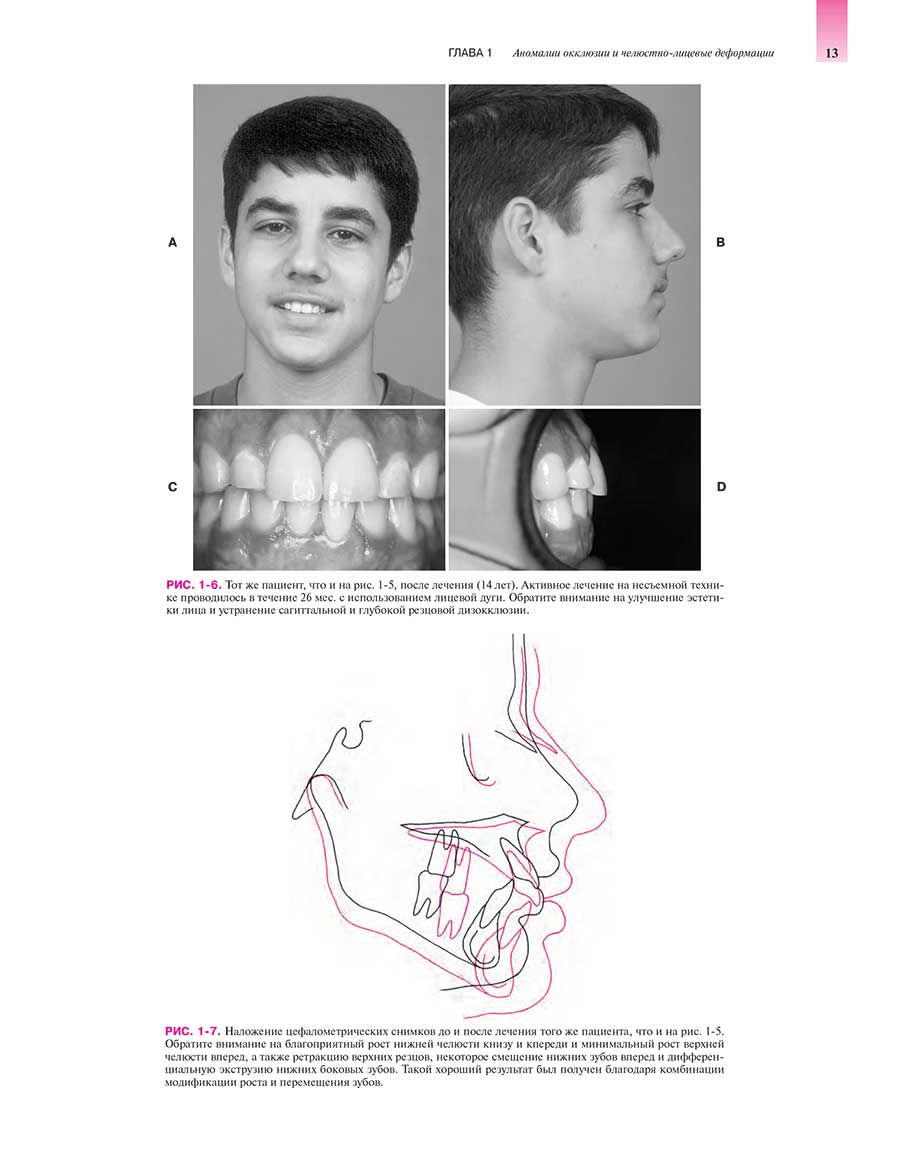 Наложение цефалометрических снимков до и после лечения