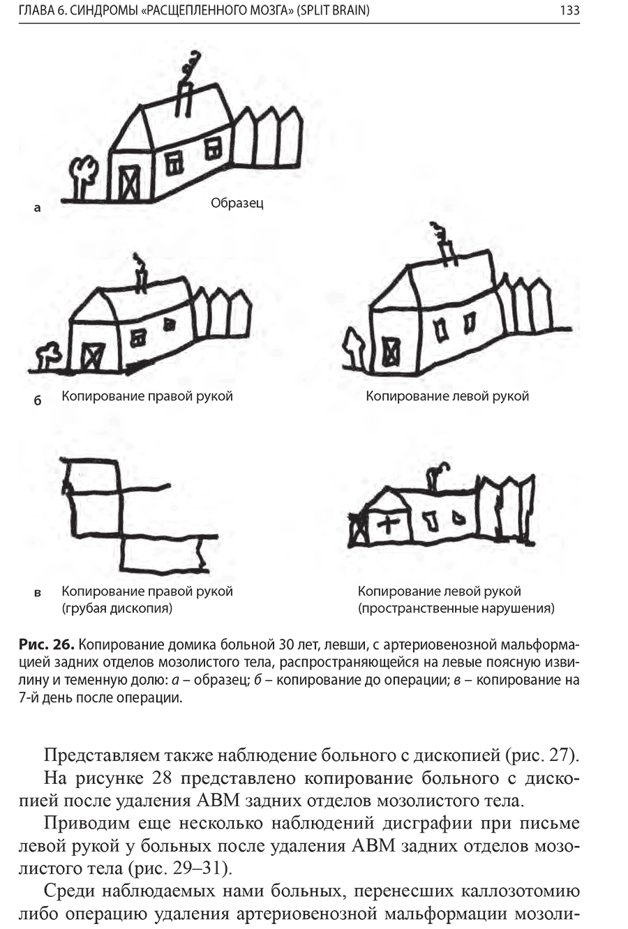 Рис. 26. Копирование домика больной 30 лет, левши, с артериовенозной мальформацией 