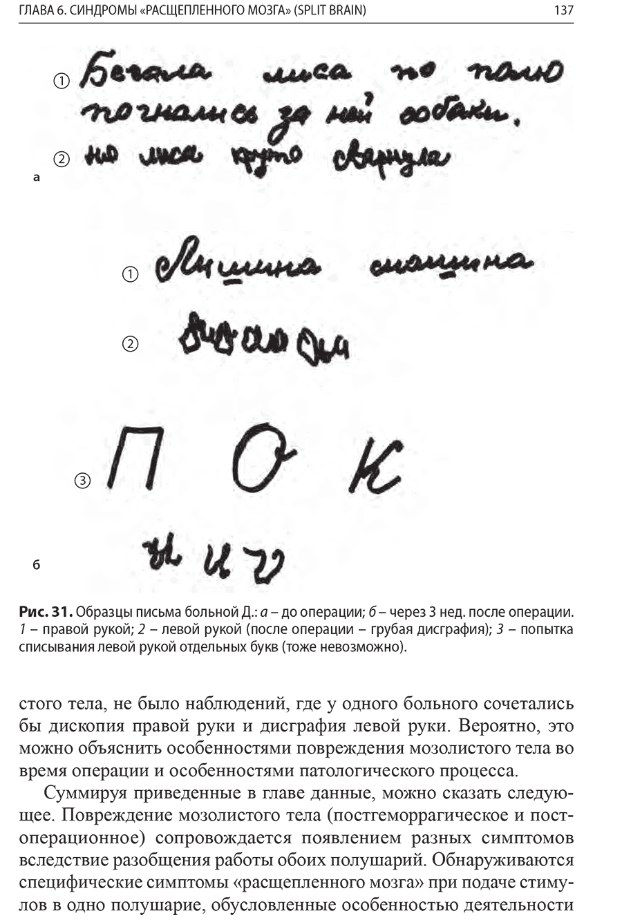 Образцы письма больной Д.: а - до операции