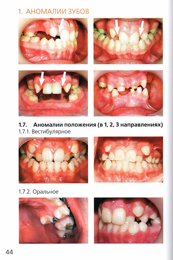 Аномалии зубов