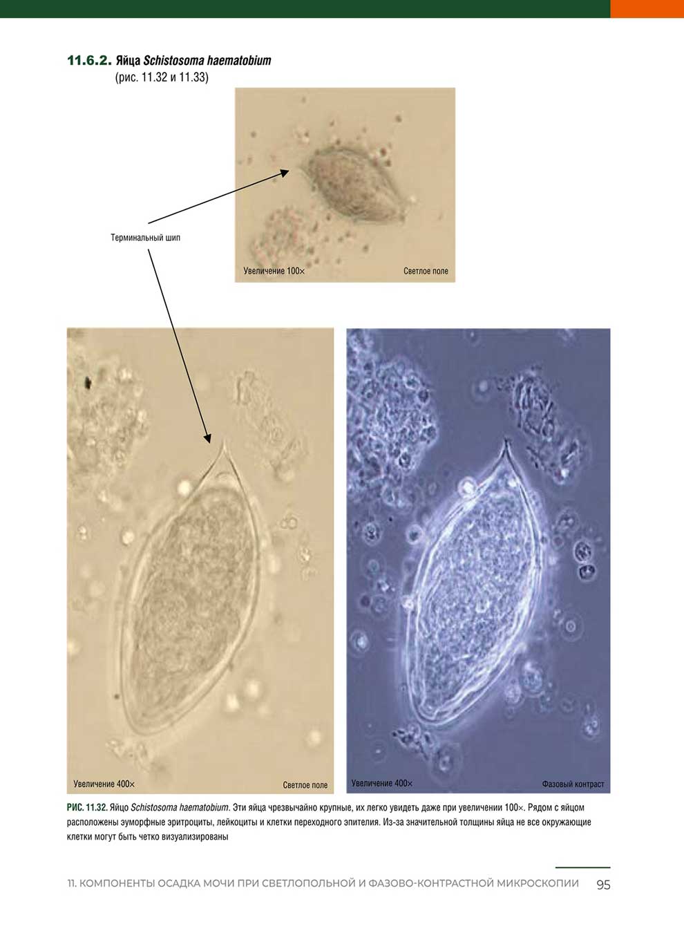 Яйца Schistosoma haematobium