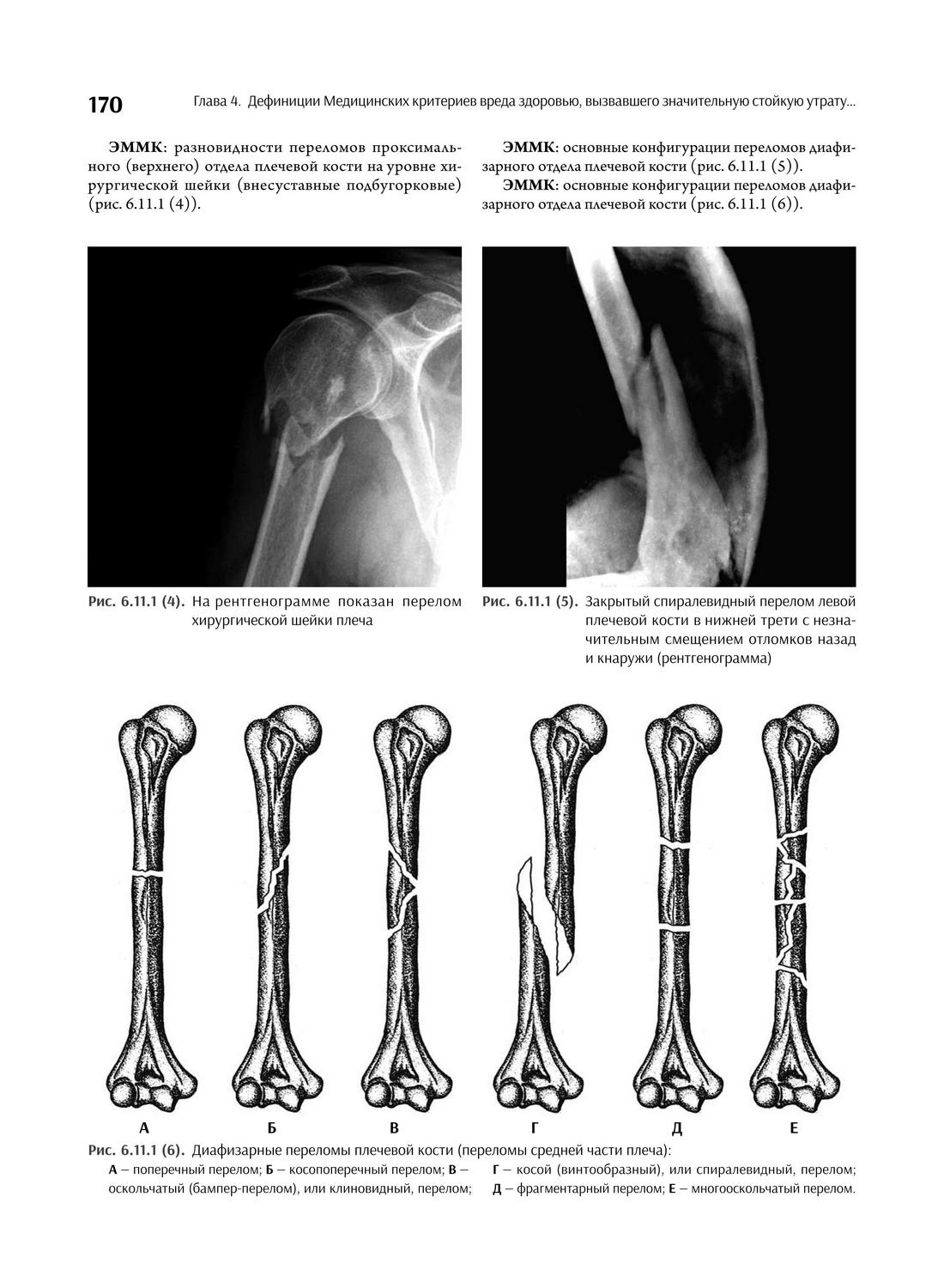 Диафизарные переломы плечевой кости (переломы средней части плеча)