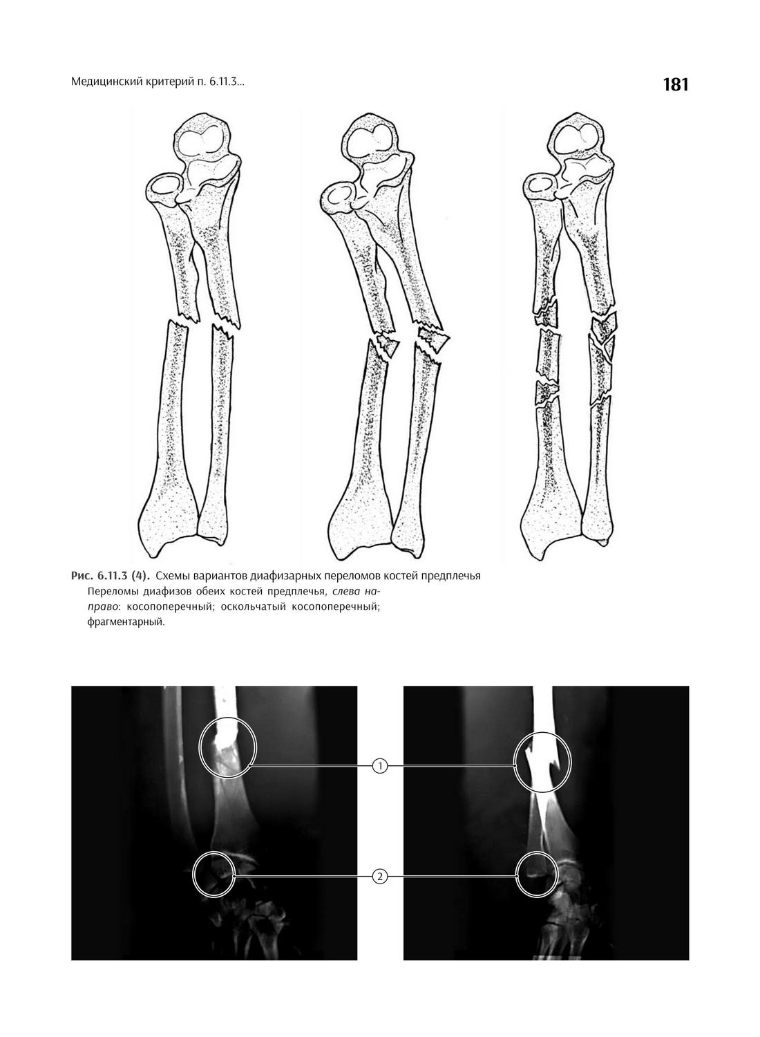 Рис. 6.11.3 (4). Схемы вариантов диафизарных переломов костей предплечья