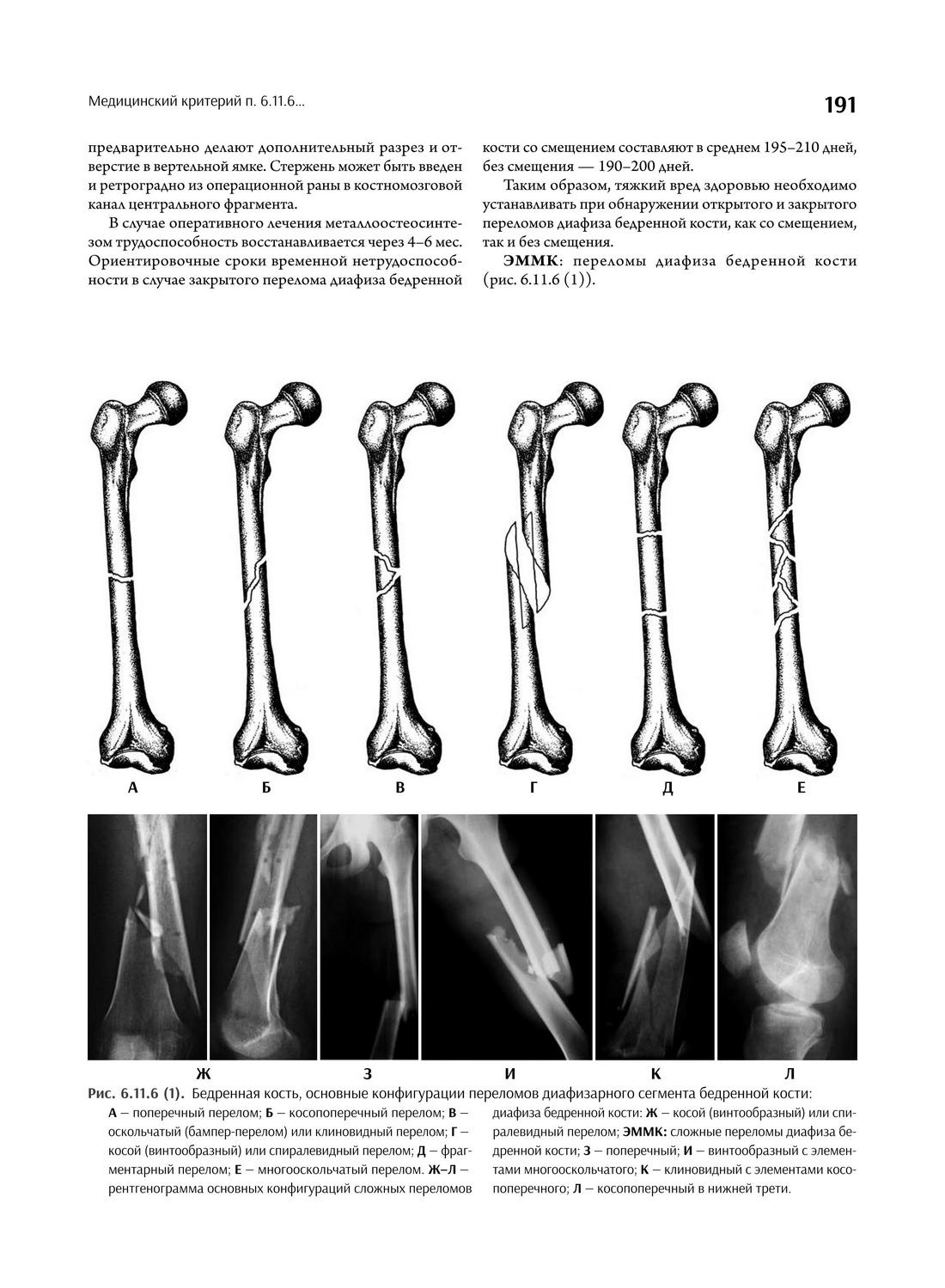 Бедренная кость, основные конфигурации переломов диафизарного сегмента бедренной кости