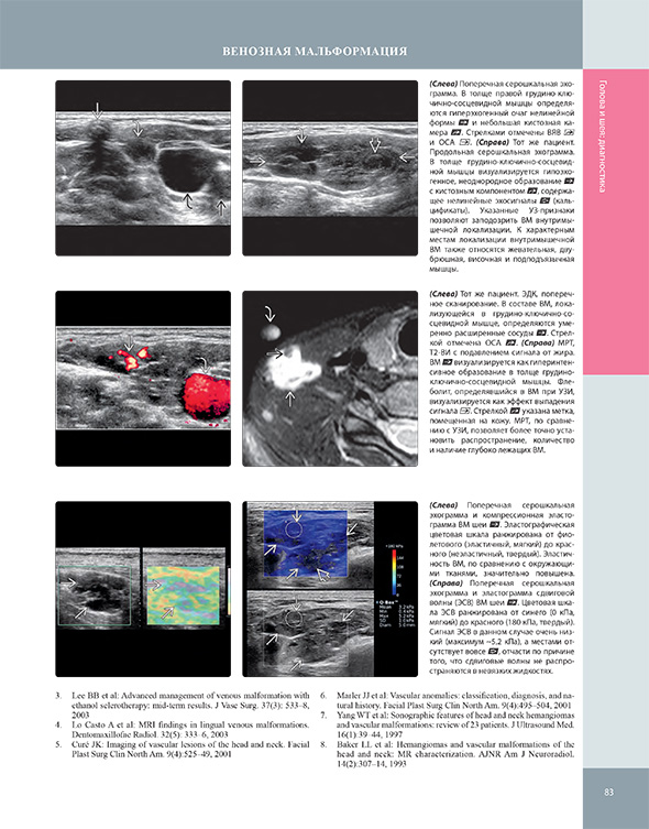 Поперечная серошкальная эхограмма и компрессионная эластограмма ВМ шеи