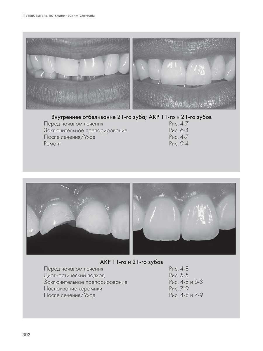 Внутреннее отбеливание 21 -го зуба; АКР 11 -го и 21 -го зубов