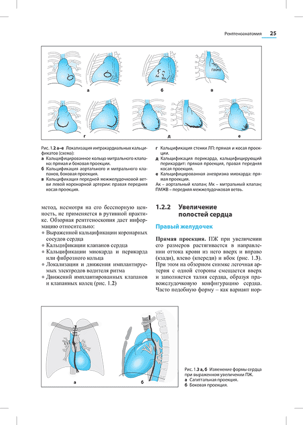 Изменение формы сердца при выраженном увеличении ПЖ.