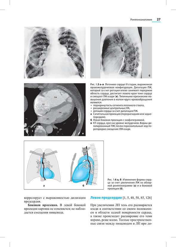 Изменения формы сердца за счет увеличения ЛЖ