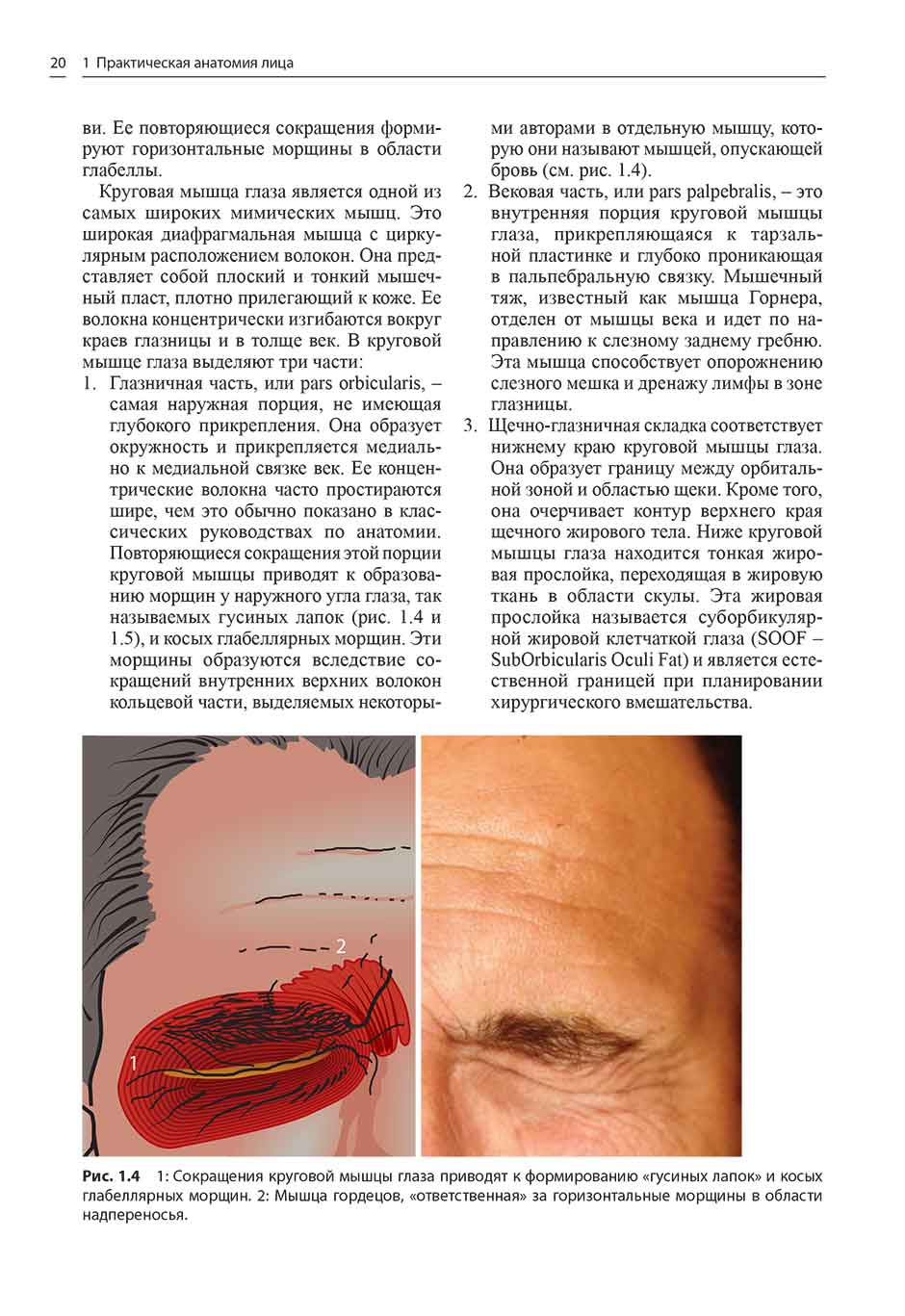 Рис. 1.4 1: Сокращения круговой мышцы глаза приводят к формированию «гусиных лапок»
