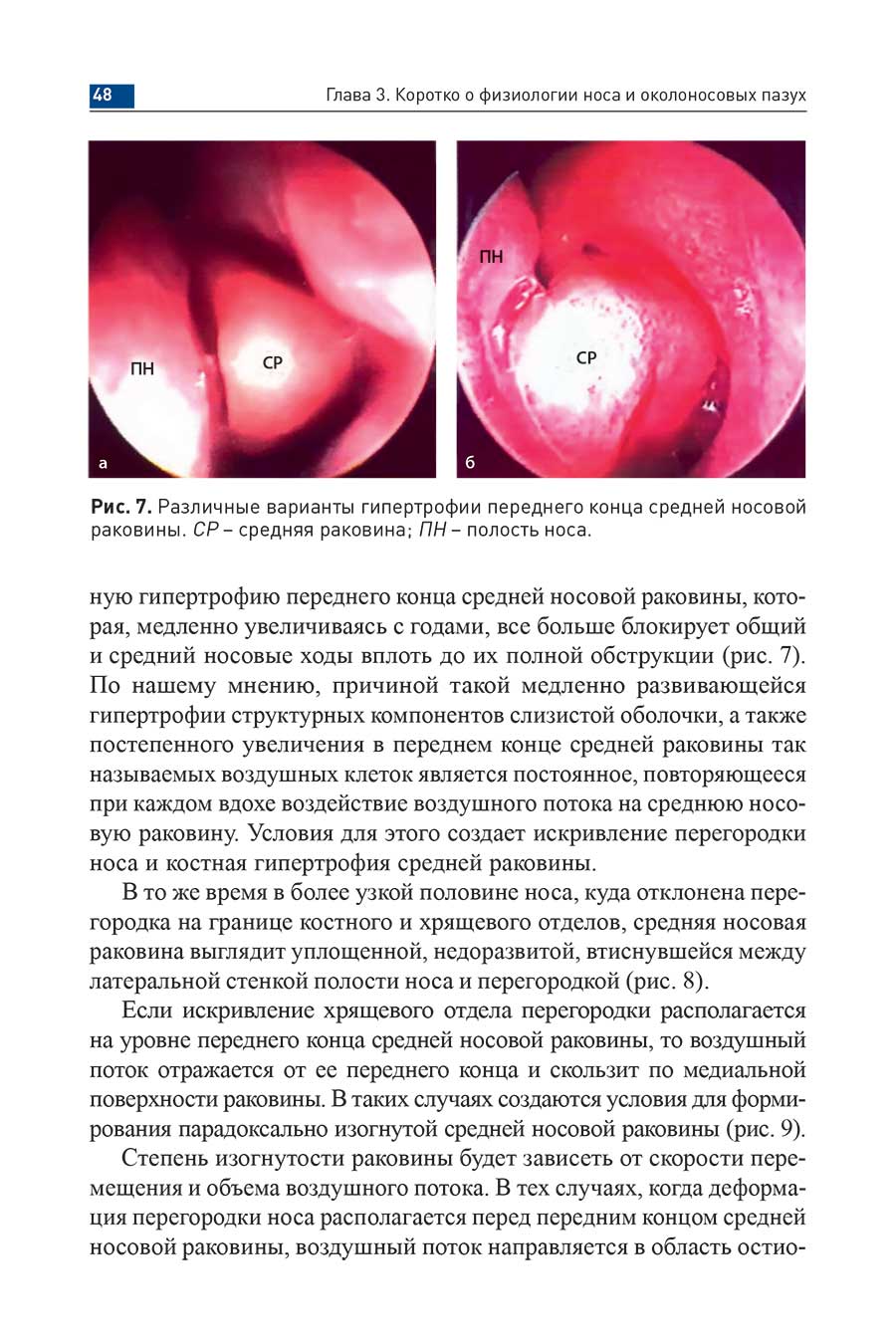 Рис. 7. Различные варианты гипертрофии переднего конца средней носовой раковины. СР-средняя раковина,- ПН - полость носа.