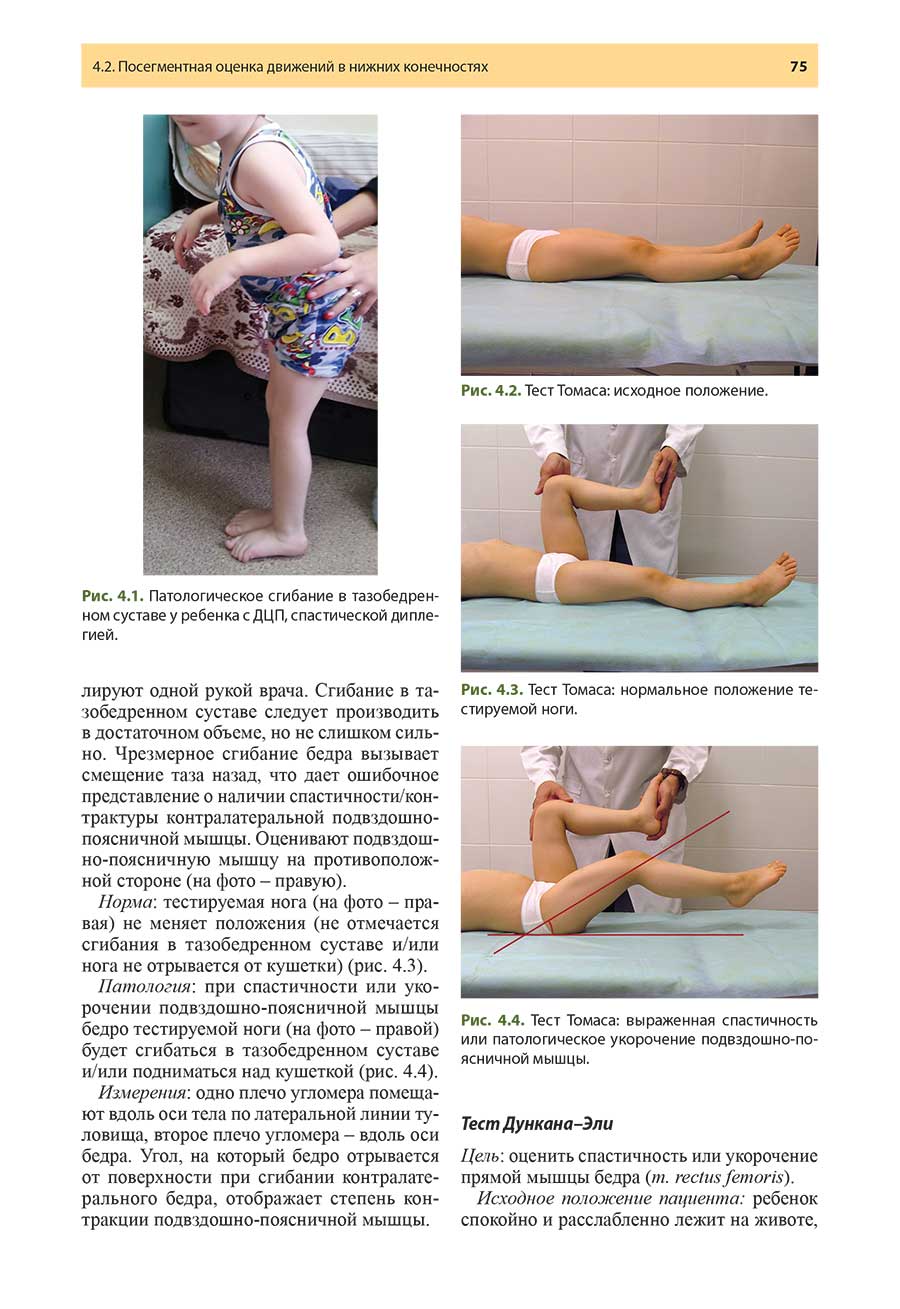 Рис. 4.1. Патологическое сгибание в тазобедренном суставе у ребенка с ДЦП, спастической диплегией.