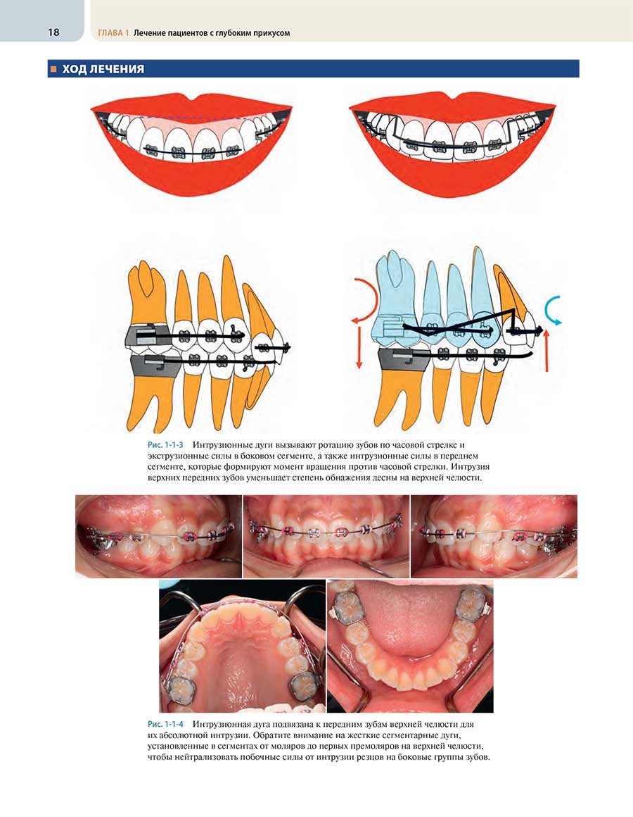 Интрузионные дуги вызывают ротацию зубов