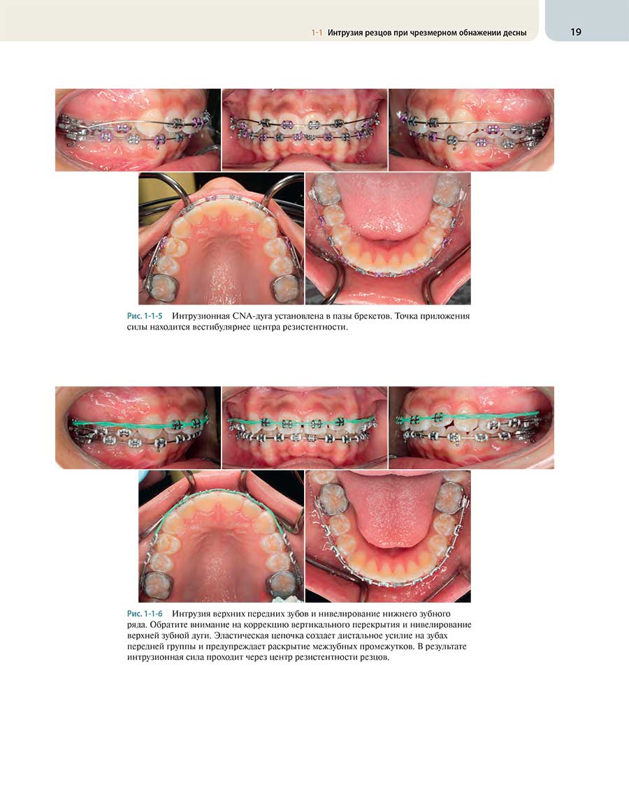 Рис. 1-1-6 Интрузия верхних передних зубов и нивелирование нижнего зубною