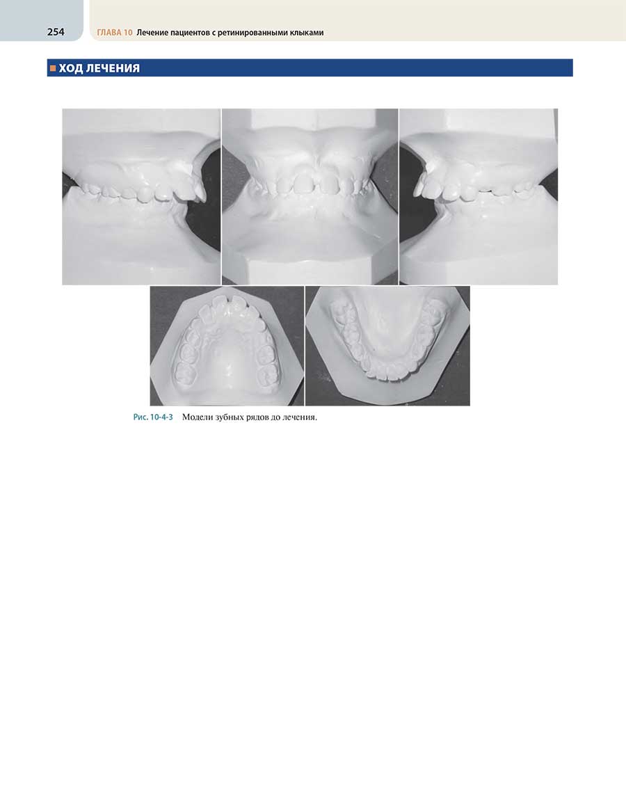 Рис. 10-4-3 Модели зубных рядов до лечения.