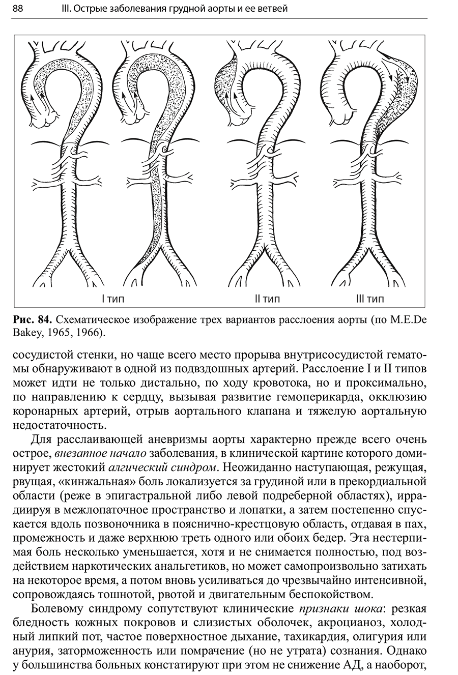 Рис. 84. Схематическое изображение трех вариантов расслоения аорты