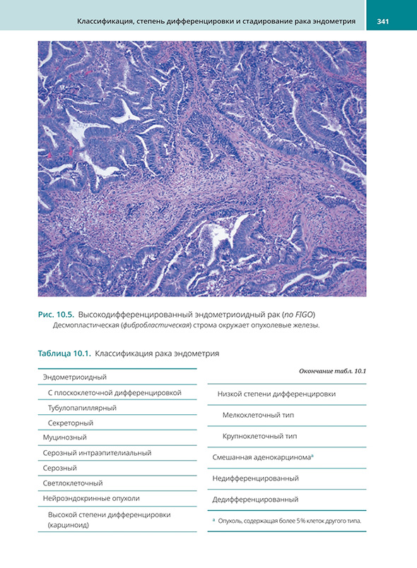 Высокодифференцированный эндометриоидный рак (no FIGO)