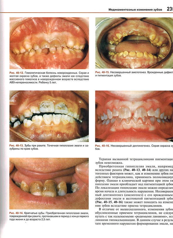 Несовершенный амелогенез. Врожденные дефект и пигментация зубов.