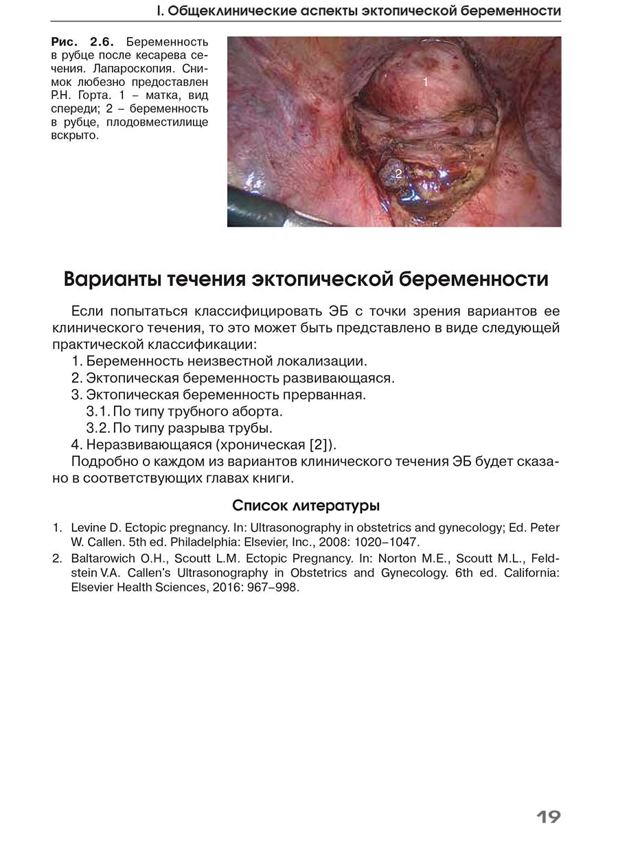 Рис. 2.6. Беременность в рубце после кесарева сечения. Лапароскопия