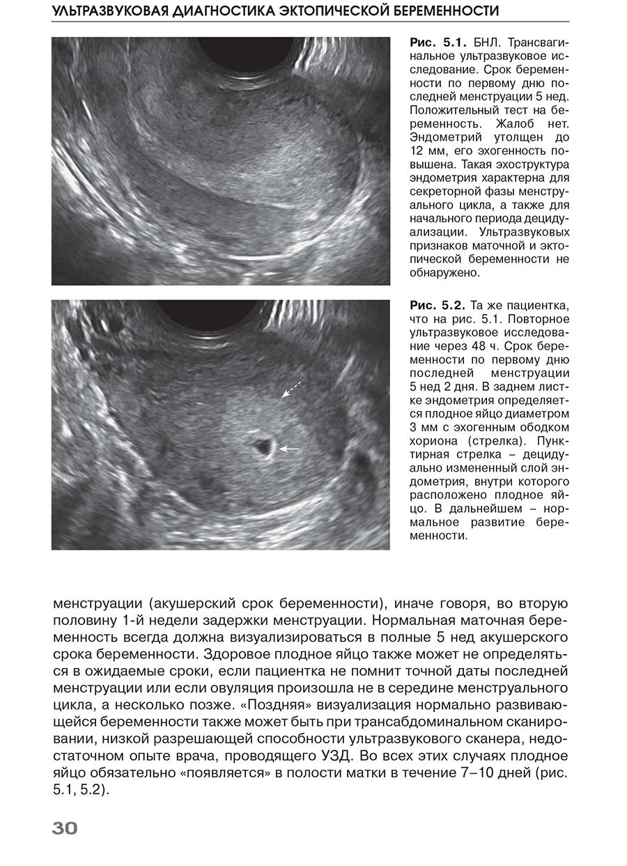 Рис. 5.1. БНЛ. Трансвагинальное ультразвуковое исследование. Срок беременности по первому дню последней менструации 5 нед.