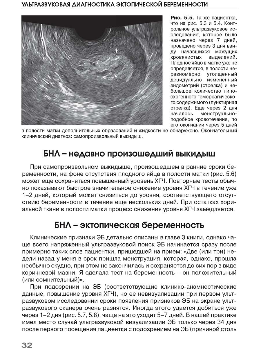 Плодное яйцо в матке уже не определяется, в полости неравномерно утолщенный децидуально измененный эндометрий (стрелка) и небольшое количество гипо-эхогенного геморрагического содержимого (пунктирная стрелка). Еще через 2 дня