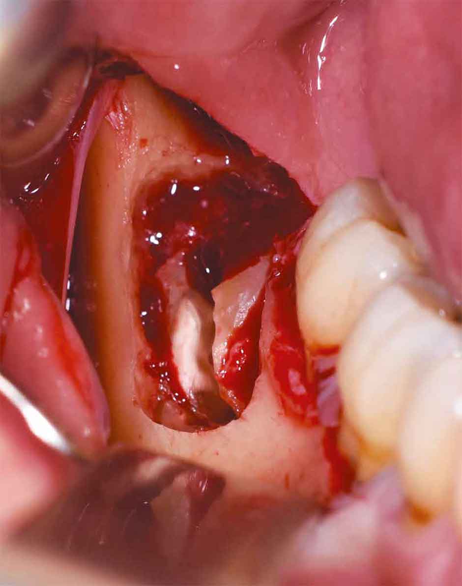 Пример страницы из книги "Пьезоэлектрическая хирургия импактных зубов" - Анджело Кардарелли