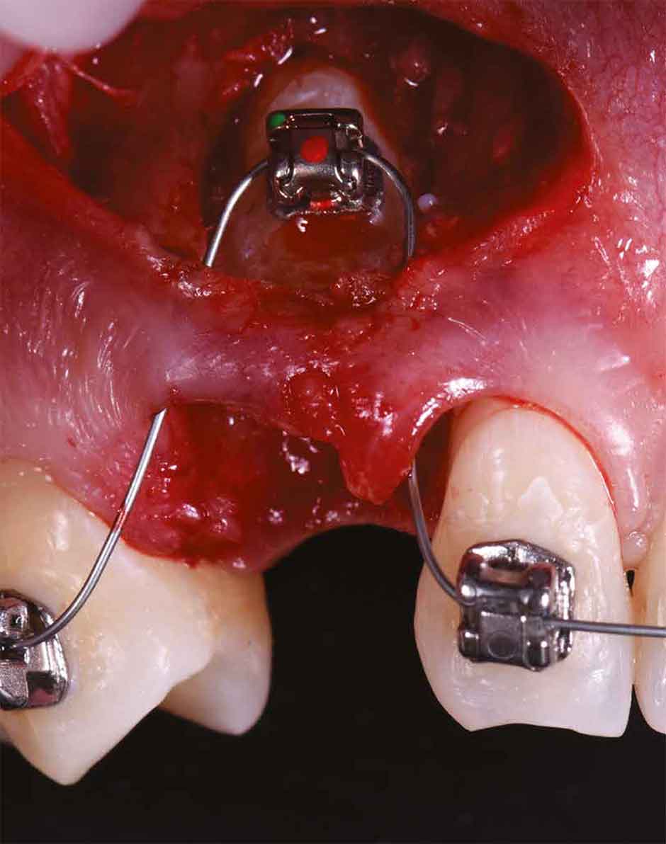 Пример страницы из книги "Пьезоэлектрическая хирургия импактных зубов" - Анджело Кардарелли