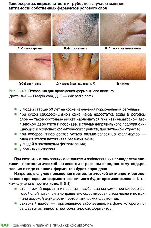 Себорея, акне