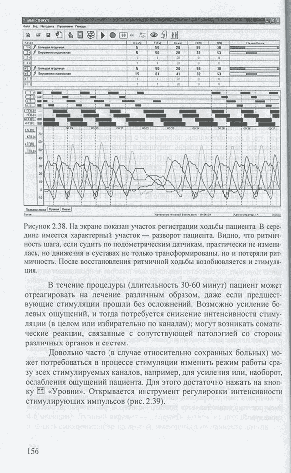 На экране показан участок регистрации ходьбы пациента.