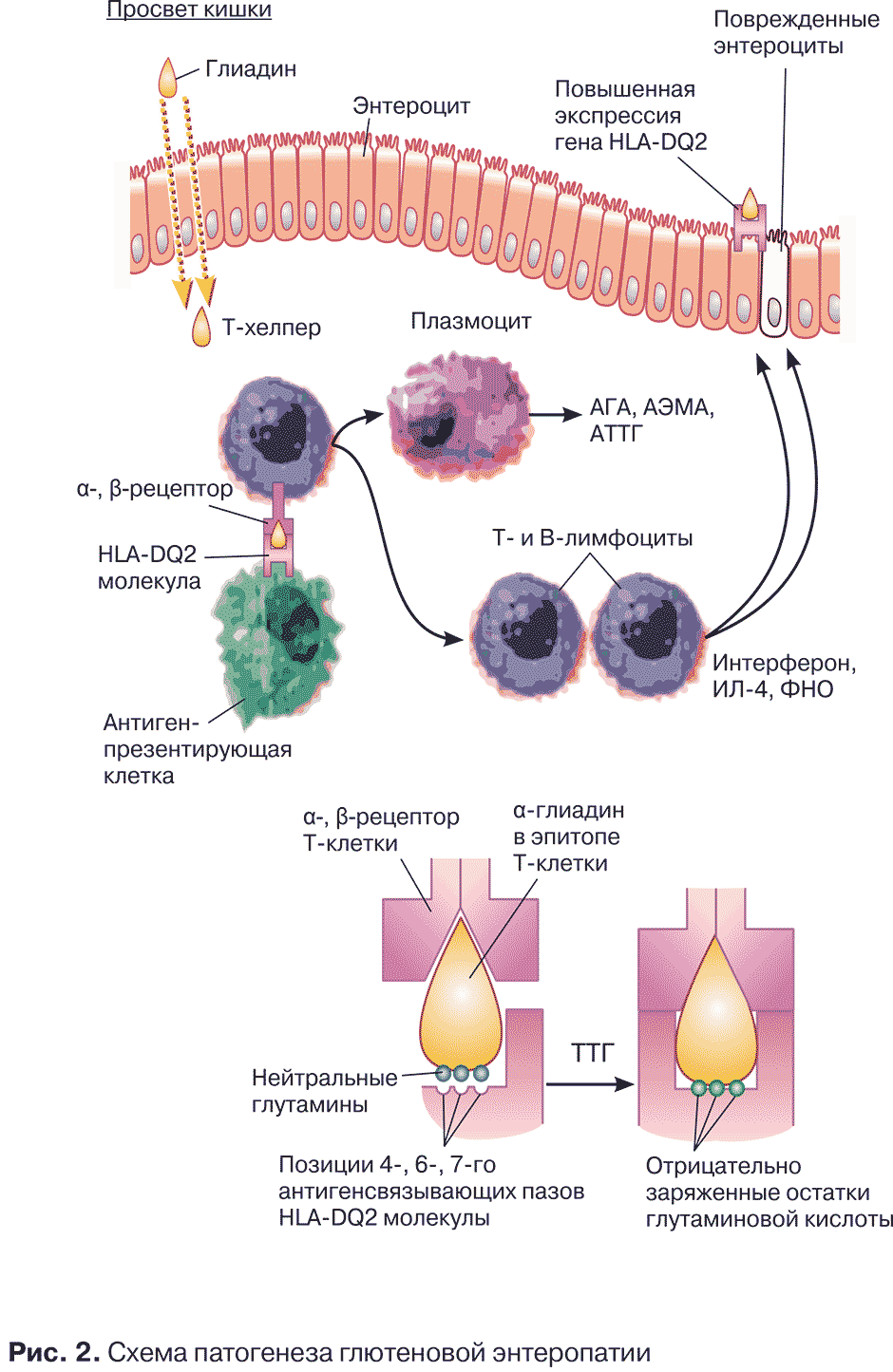 Рис. 2. Схема патогенеза глютеновой энтеропатии