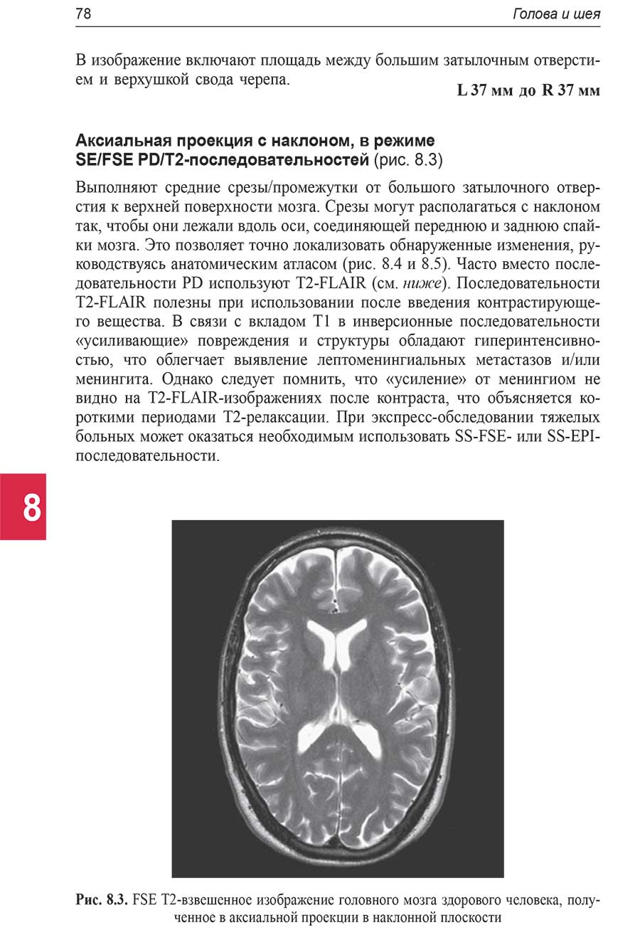 FSE T2-взвешенное изображение головного мозга здорового человека,