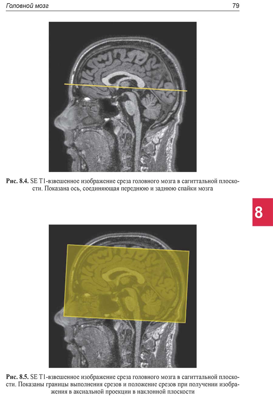 SE T1-взвешенное изображение среза головного мозга