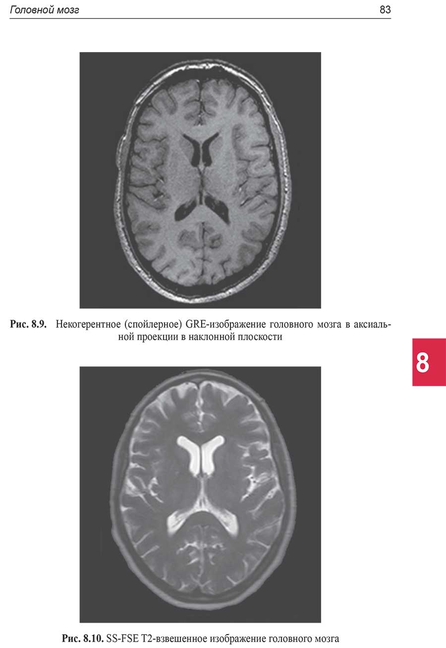 SS-FSE Т2-взвешенное изображение головного мозга