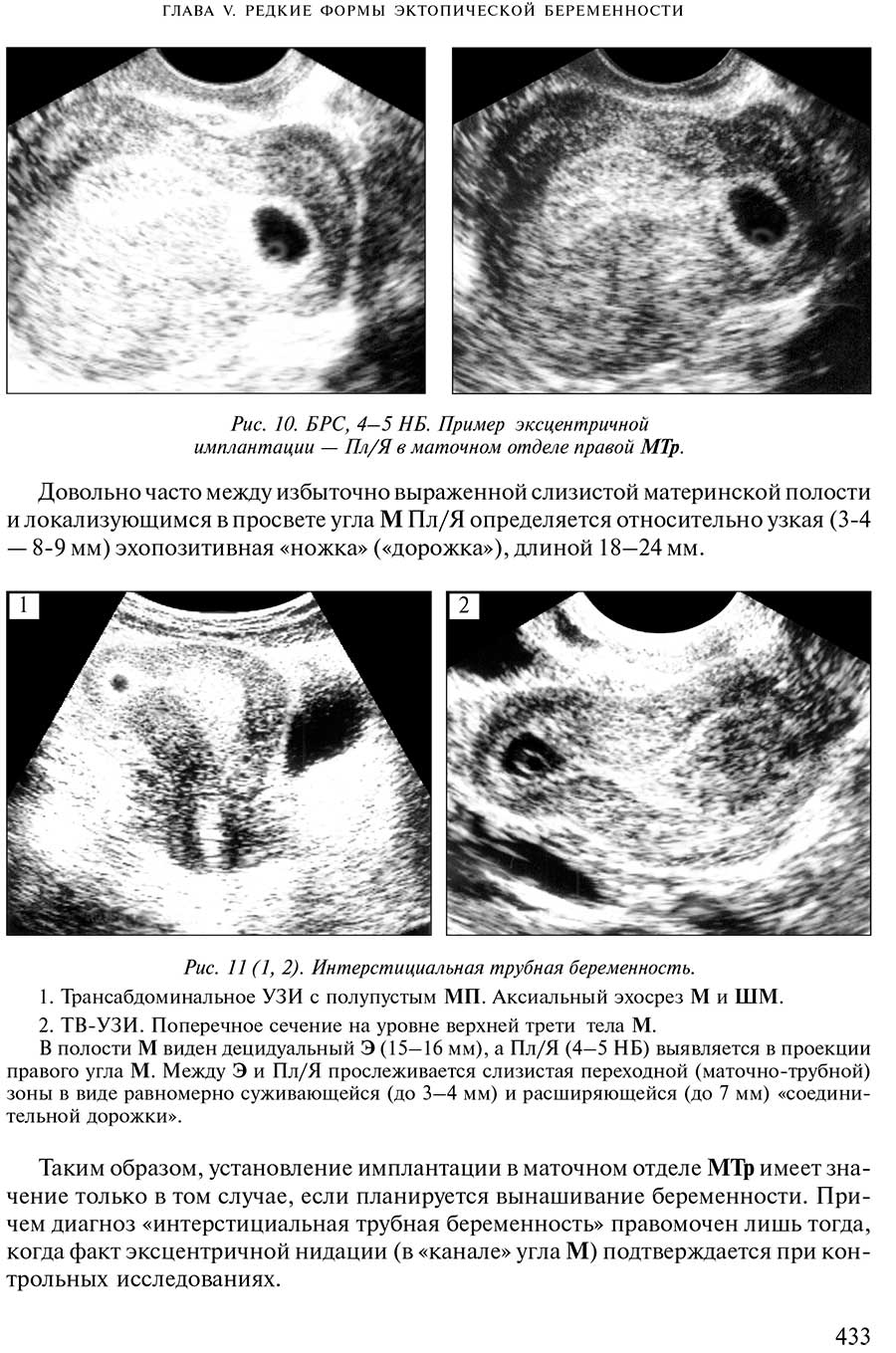Рис. 11 (1,2). Интерстициальная трубная беременность.