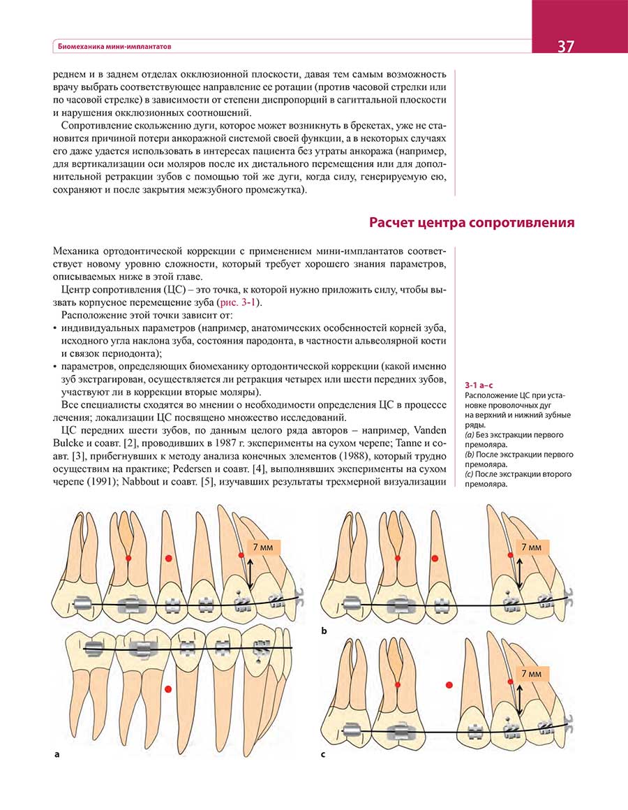 Расположение центра сопротивления при установке проволочных дуг на верхний и нижний зубные ряды.
