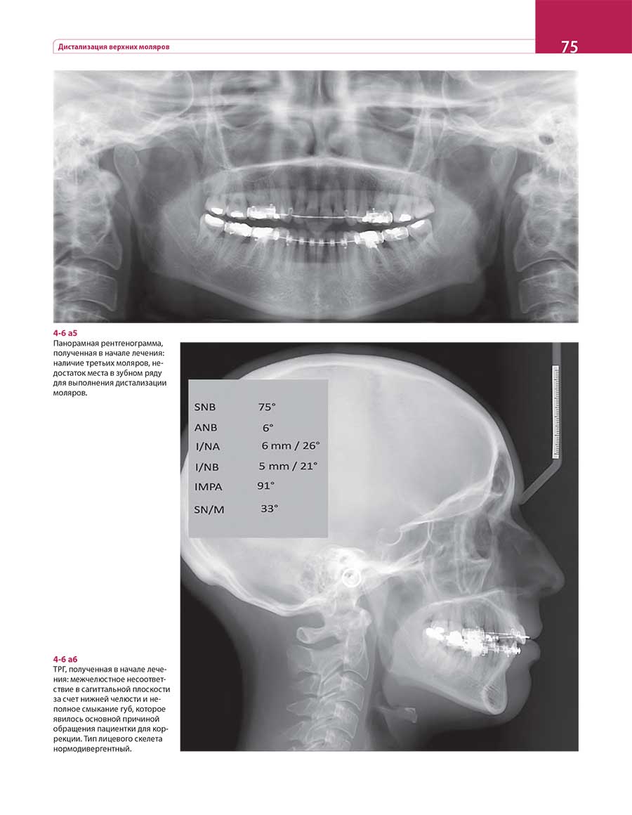 Панорамная рентгенограмма, полученная в начале лечения: наличие третьих моляров