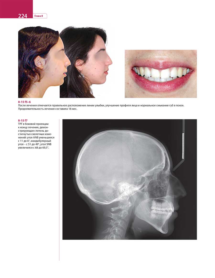 После лечения отмечается правильное расположение линии улыбки, улучшение профиля лица и нормальное смыкание губ в покое.