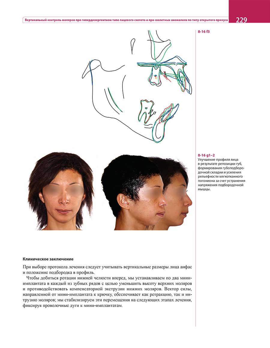 Улучшение профиля лица в результате репозиции губ.