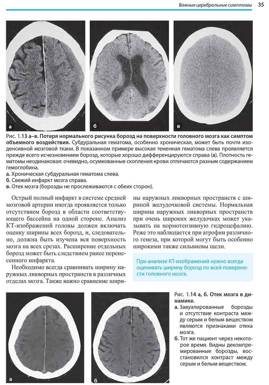 Рис. 1.13 а-в. Потеря нормального рисунка борозд на поверхности головного мозга