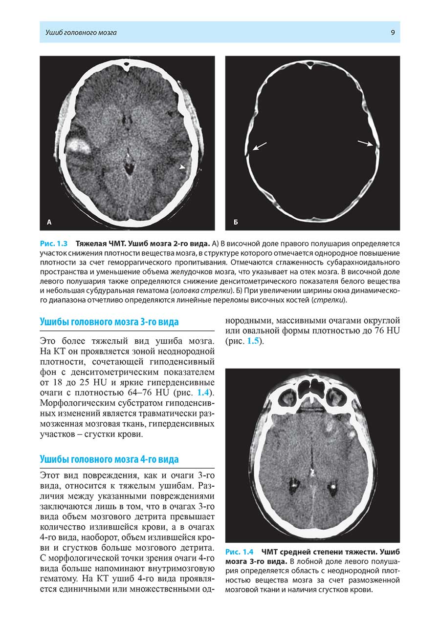 Очаги в головном мозге на МРТ