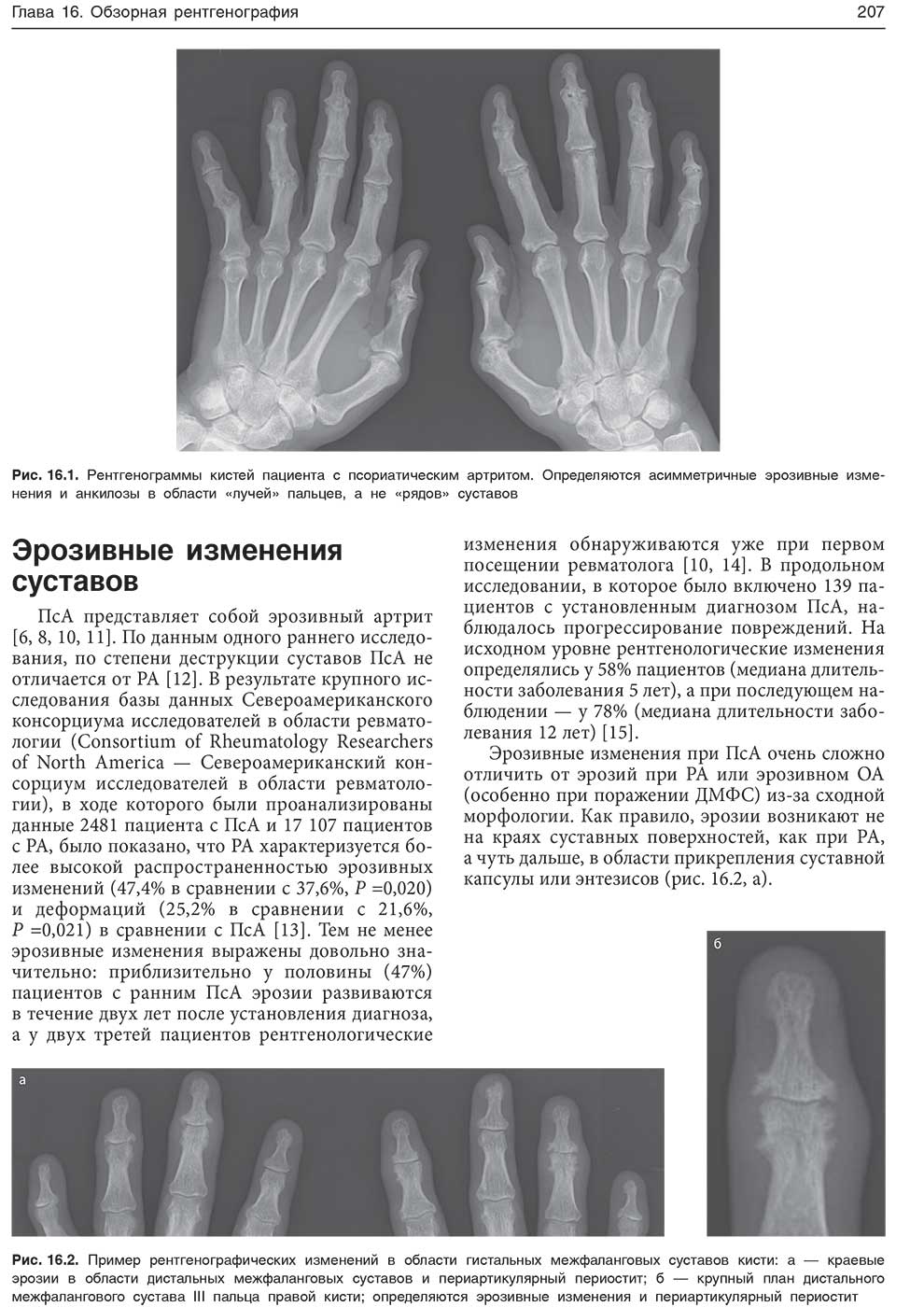 Пример рентгенографических изменений в области гистальных межфаланговых суставов кисти: