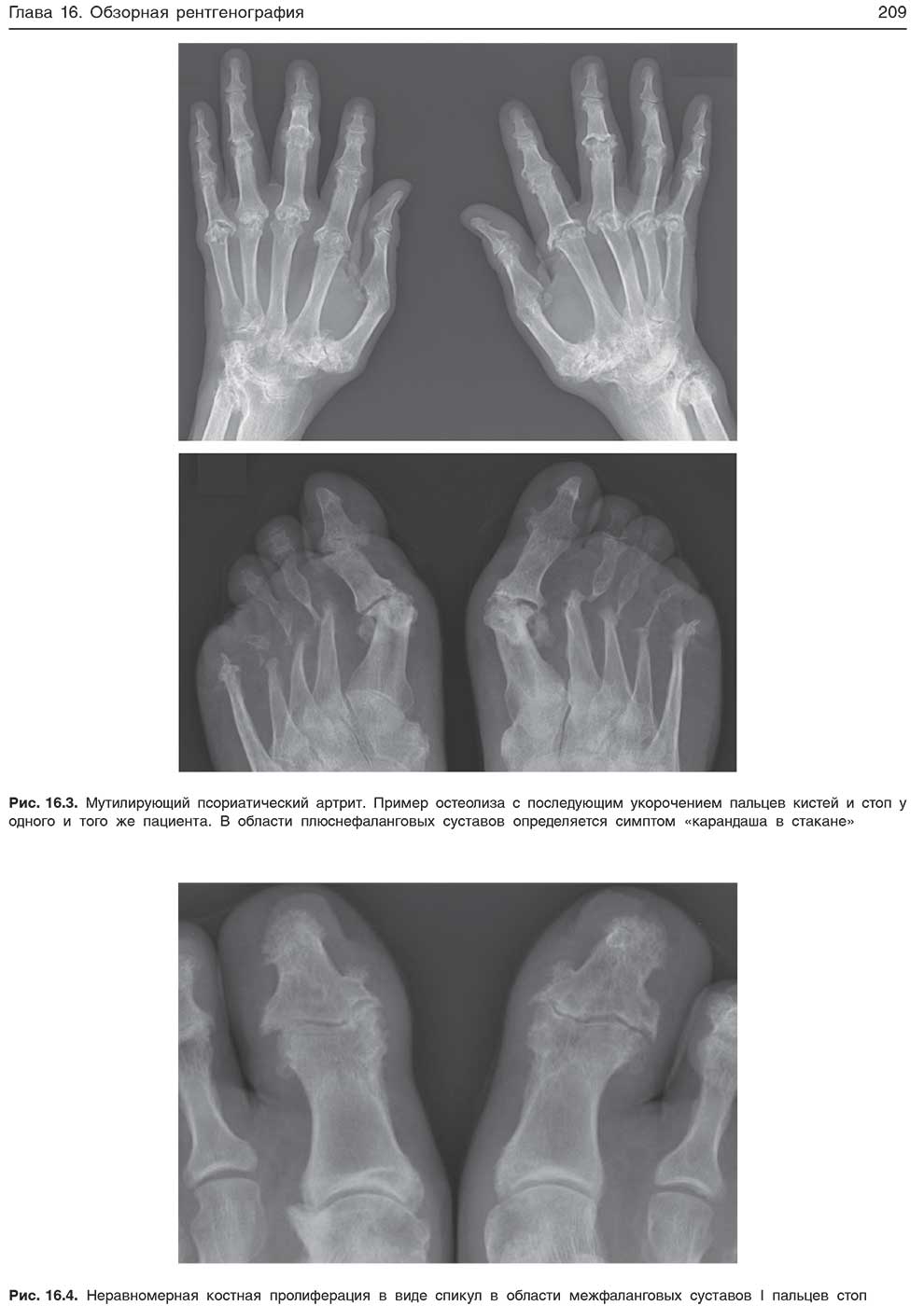 Неравномерная костная пролиферация в виде спикул в области межфаланговых суставов