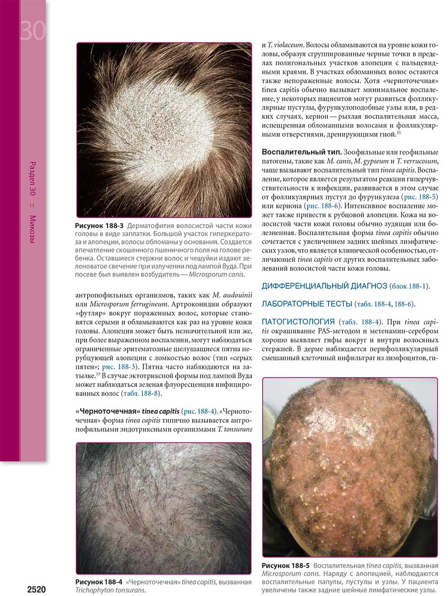 Дерматофития волосистой части кожи