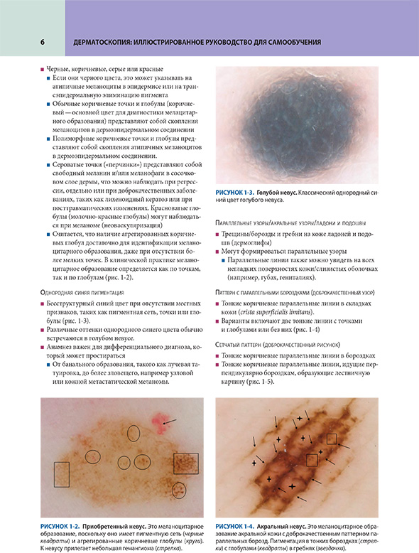 Голубой невус Голубой невус