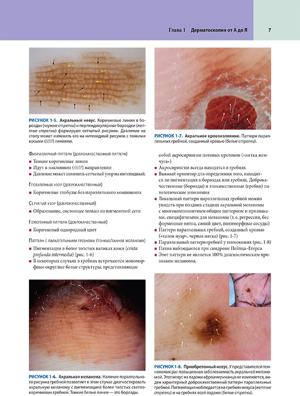 Акральное кровоизлияние Акральное кровоизлияние