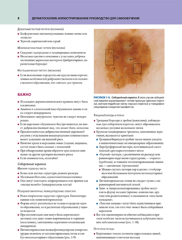 Себорейный кератоз Себорейный кератоз