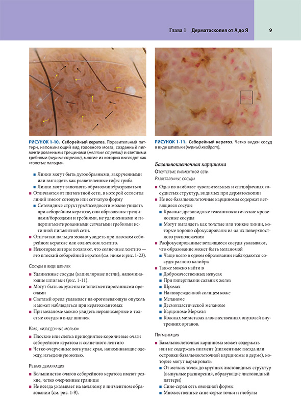 Себорейный кератоз Себорейный кератоз