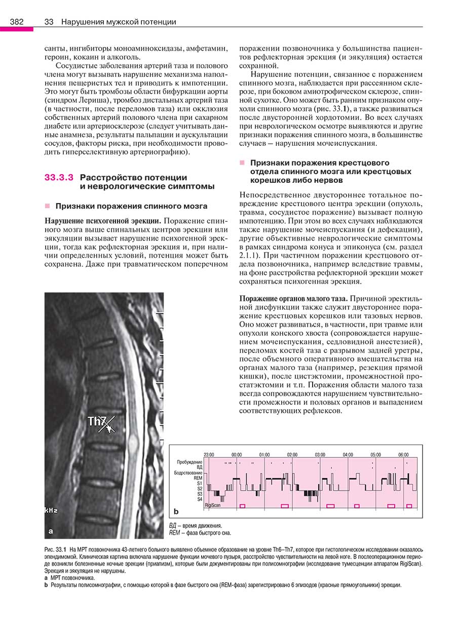 МРТ позвоночника 43-летнего больного выявлено объемное образование