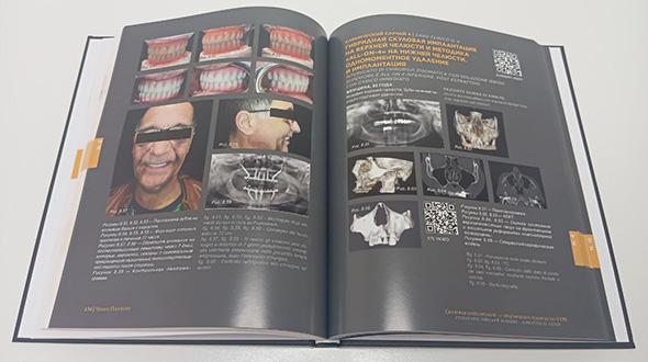 Примеры страниц из книги "Скуловая имплантация. Практическое руководство" - Чезаре Паолески